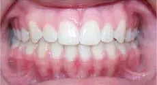 Teeth Alignment After Treatment 
