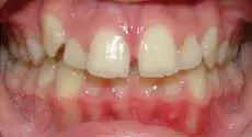 Teeth Alignment Before Treatment