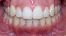 Teeth Alignment After Treatment 