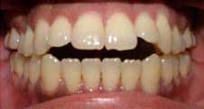 Teeth Alignment Before Treatment