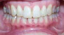 Teeth Alignment After Treatment 