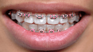 Braces