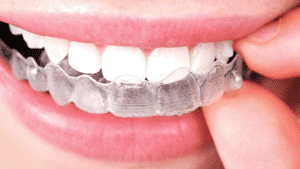 Clear Aligners